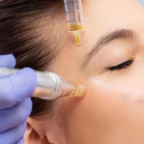 Microneedling (2) Microneedling (2)
