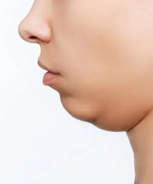 double chin double chin