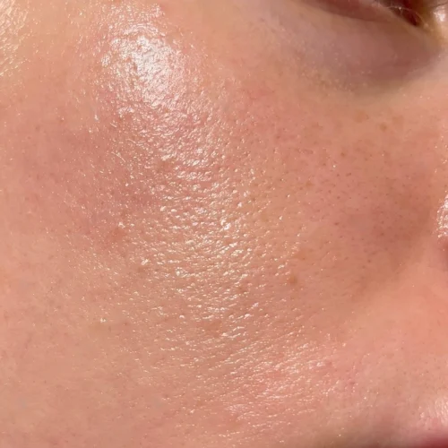 oily_skin (1) oily_skin (1)