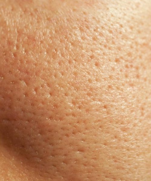 open pores open pores