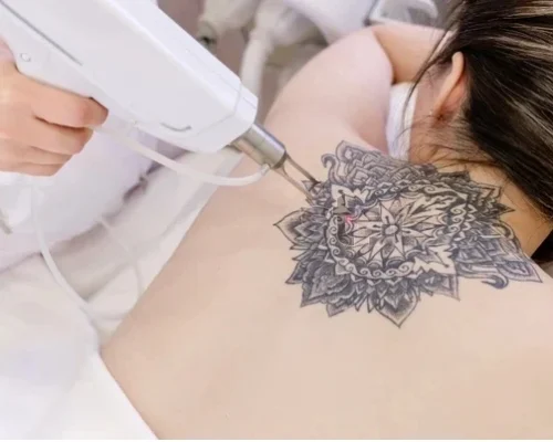 tatoo-removal-transformed tatoo-removal-transformed