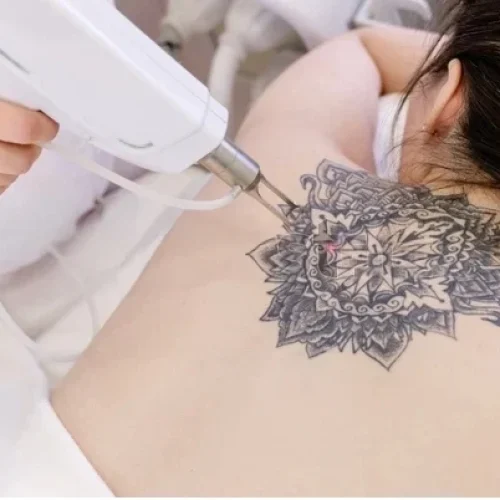 tatoo-removal-transformed tatoo-removal-transformed