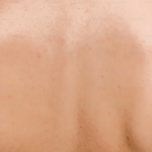 uneven-skin-tone uneven-skin-tone